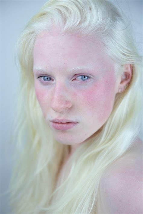 I took a picture of a beautiful girl with albinism. #elsa Pretty People ...