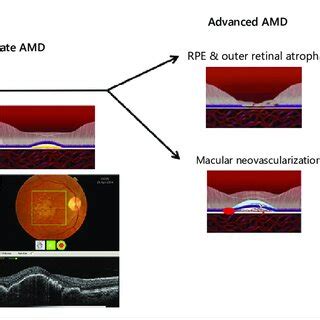 Different stages of AMD starting at normal aging, going through ...