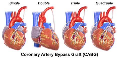 Coronary Artery Bypass Grafting (CABG) - almostadoctor