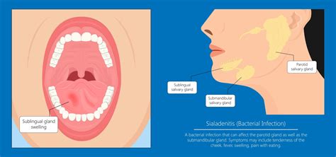 Submandibular Gland Swelling In Children