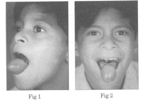 MANAGEMENT OF AN EXTRAORDINARY LARGE MUCOCELE OF THE TONGUE WITH UNUSUAL PRESENTATIONS ...