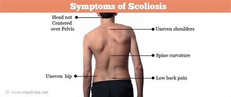 Scoliosis - Facts, Causes, Types, Symptoms & Treatment