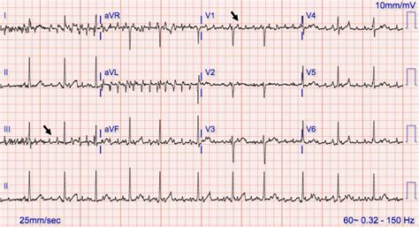 Atrial Fib Vs Flutter