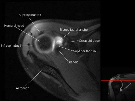 Shoulder_Arthrogram