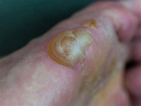 Eczema Affected A Foot Dermatology Skin Disease Affect Allergy ...