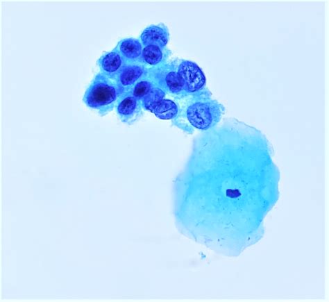 Pathology Outlines - HSIL (cytology)