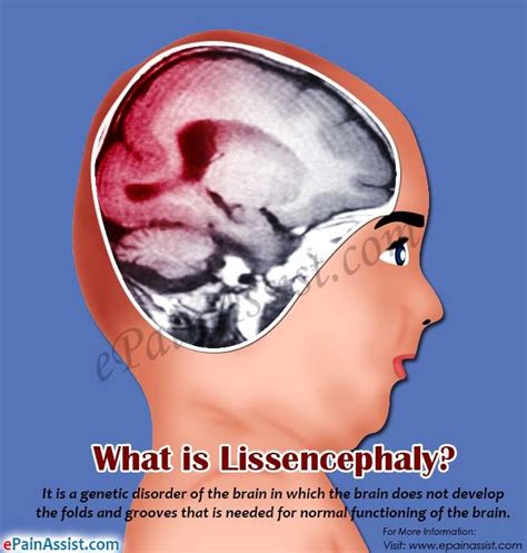 Lissencephaly