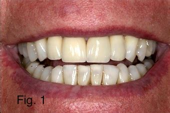 Positioning Maxillary Central Incisal Edges: Finalizing Incisal Edge Position - Spear Education