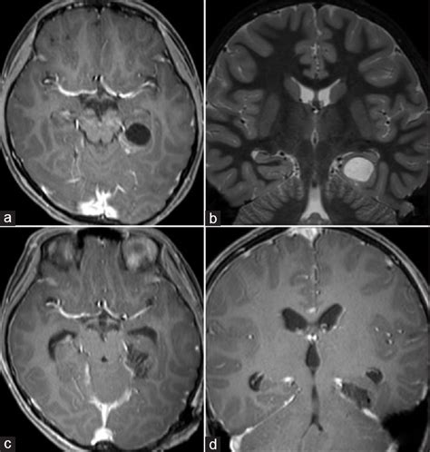 Seizure freedom from temporal lobe epilepsy with mesial temporal lobe ...