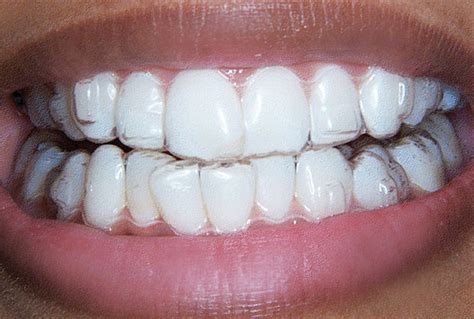 gouttière de traitement Invisalign