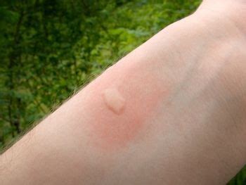 Mosquito Bites – Pictures, Itch, Swelling, Prevention and Treatment