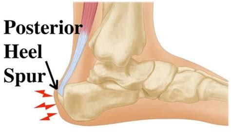 Bone spurs of the heel of foot defined and treatments