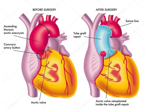 Thoracic aortic aneurysm surgery Stock Vector Image by ©rob3000 #78599176