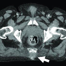 72-year-old Man with Sacral Decubitus Ulcer. A-C, Axial PET, CT and... | Download Scientific Diagram