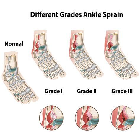 Sprained Ankle Clipart