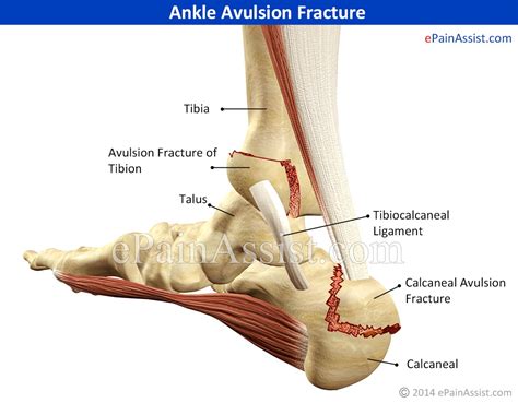 Ankle Avulsion Fracture|Symptoms|Causes|Treatment|Recovery Time|Exercises