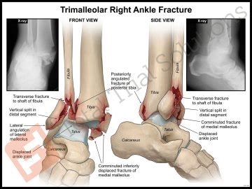 Medical & Surgical Illustrations | Right Ankle | ORIF – Total Trial Solutions