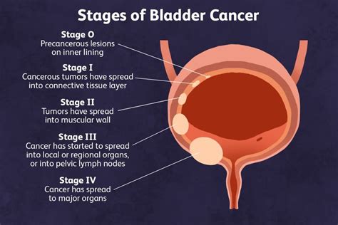 Stages of Bladder Cancer: What You Need to Know