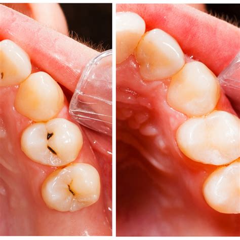 Composite Filling Material | Joseph P. Sexton, DDS