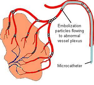 Embolization for Bleeding | University of Michigan Health