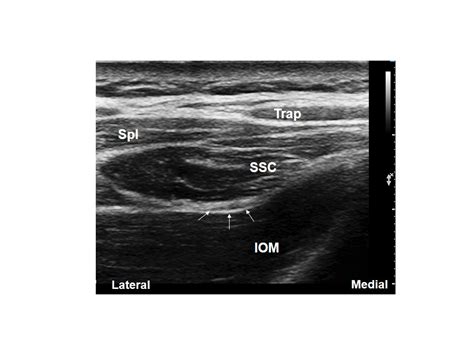 Occipital Nerve Block (Ultrasound) - Samer Narouze, MD, PhD