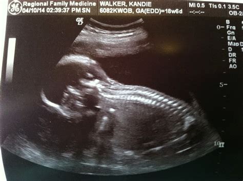 The Walker Family Blog: Ultrasound and Gender Reveal!!!