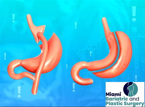 Best Miami Revisional Weight Loss Surgery doctors | Bariatric Clinic