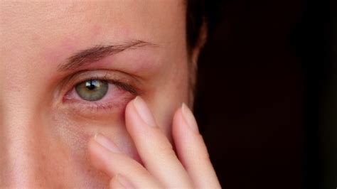 Alcoholic Eyes Symptoms and Treatment - Bodhi Addiction