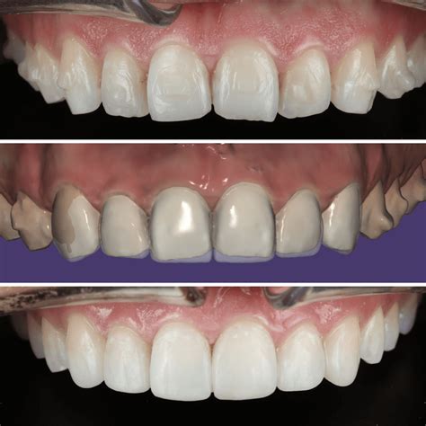 Composite Resin Bonding | Helix Dental Mermaid Water