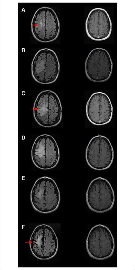 MRI progression of progressive multifocal leukoencephalopathy (PML) and... | Download Scientific ...