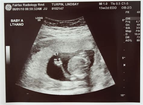 Adventures in Baby Making: 16 Weeks Ultrasound Pics