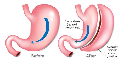 Gastric sleeve surgery - Dr Abdollah Zandi