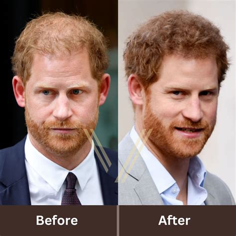 Prince Harry's Hair Transplant: Before and After Transformation