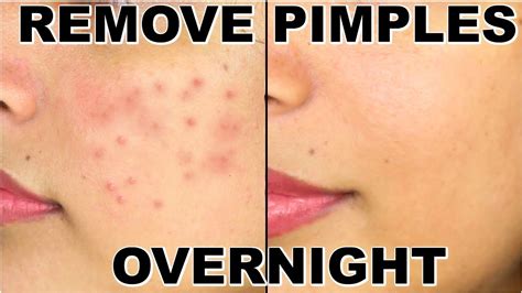 How to Remove Pimples Fast | Best Home Remedies for Pimples | Remove ...