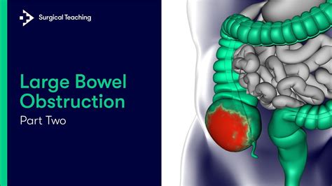 Large Bowel Obstruction Part 2 | The Anatomy of the Large Bowel - YouTube