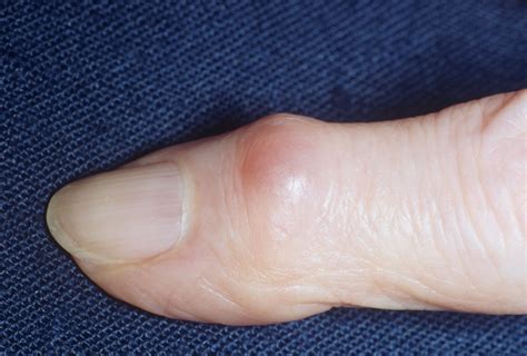 Lumps Under Your Skin Firm bumps or "nodules" under your skin may be the fir… | Rheumatoid ...