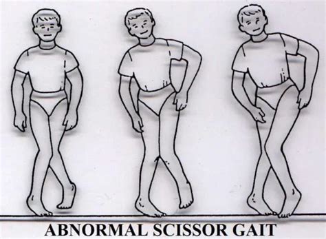 Spastic Diplegia - Cause, Symptoms, Treatment