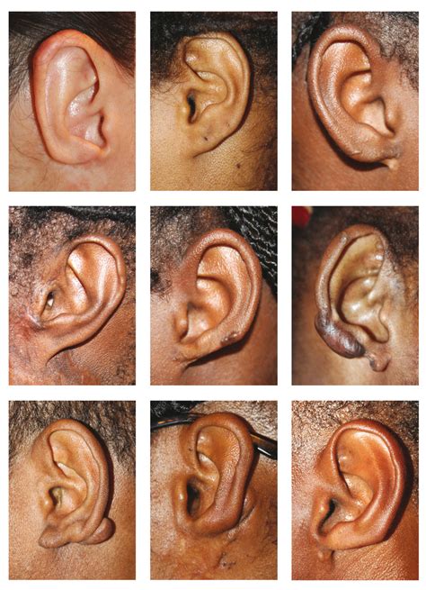 Massive ear keloids: Natural history, evaluation of... | F1000Research