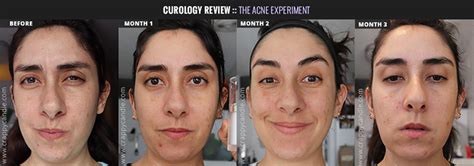 Curology Review - The Acne Experiment | Crappy Candle