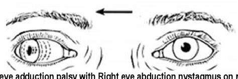 Figure IV from Bilateral Internuclear Ophthalmoplegia as a Presenting ...