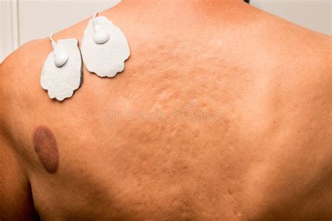 Patient that Had Cupping Therapy Done on His Upper Back Stock Image ...