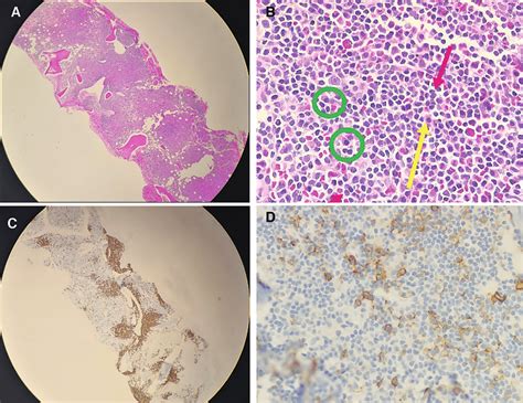 Bone marrow trephine biopsy. A Bone marrow trephine at ×4... | Download ...