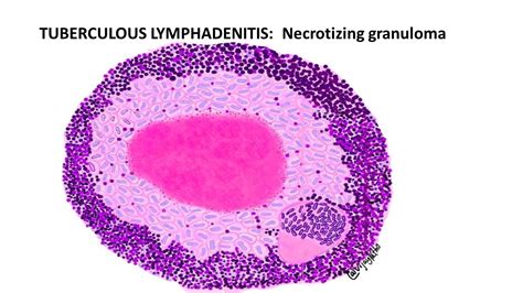 TUBERCULOUS LYMPHADENITIS - Pathology Made Simple