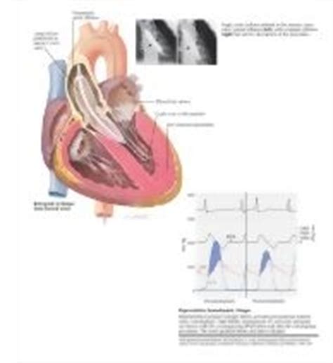 Aortic Balloon Valvuloplasty