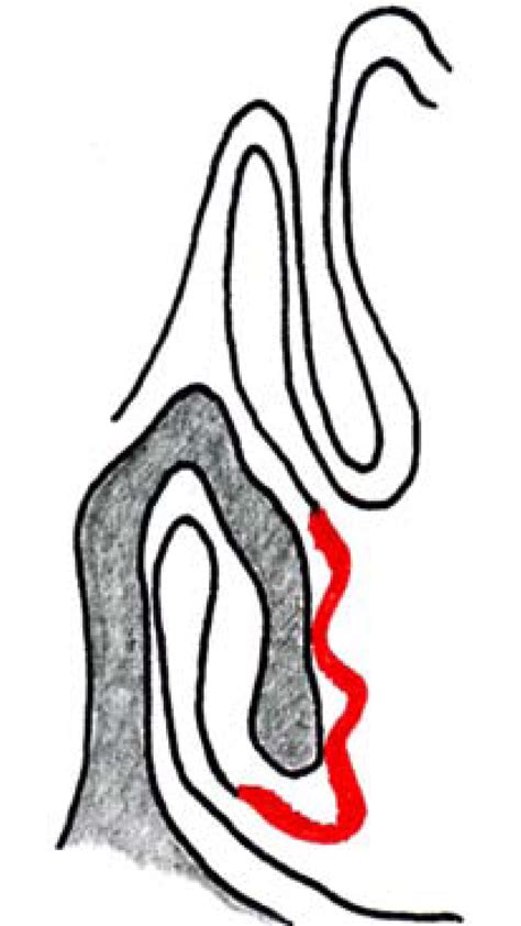 Laser surgery of the inferior turbinate | Download Scientific Diagram