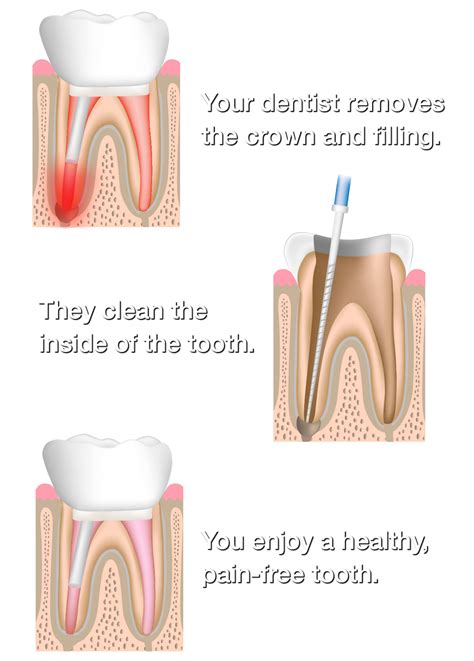 Root Canal Retreatment