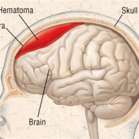 Subdural Hematoma Causes Signs Diagnosis Treatment - vrogue.co