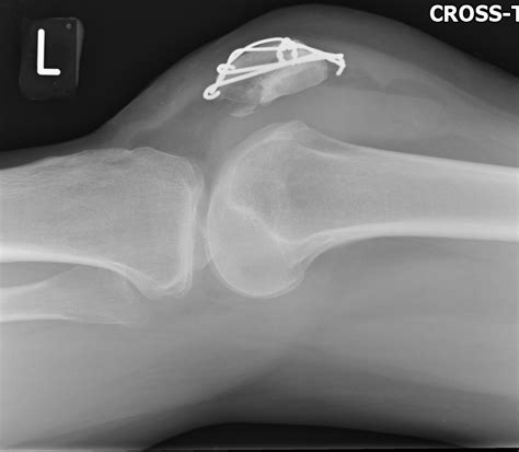 Patellar fracture fixation: An unreported complication occurring ...