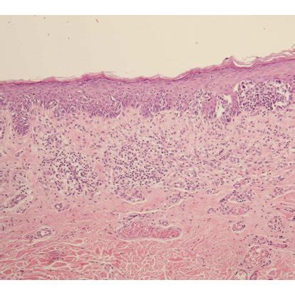 Intradermal atypical nevus cells in the left part of the biopsy ...