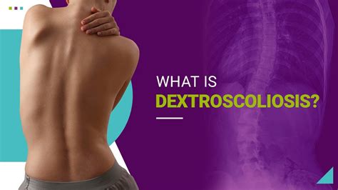 What is Dextroscoliosis? - YouTube